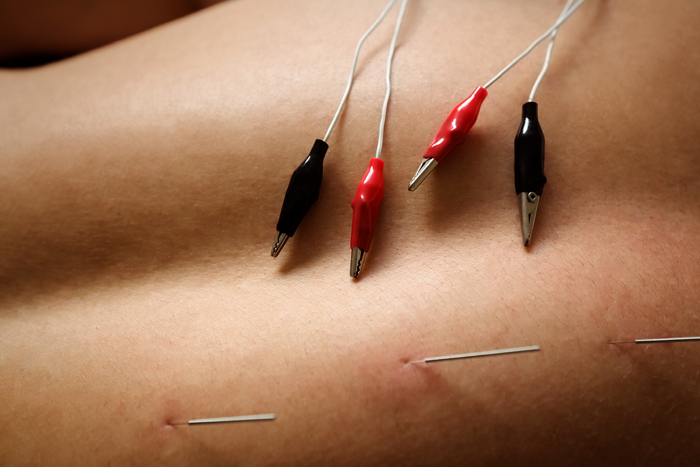 acupunctura
