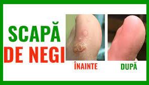 Cum scapam de negi