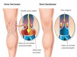 Varicele